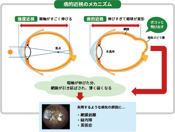 病的近視のメカニズム 病的近視のメカニズム